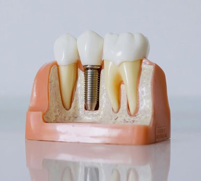 Permanent tooth replacement options that look, feel, and function like natural teeth.